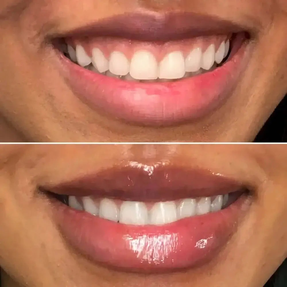 LipFix: Gummy Smile